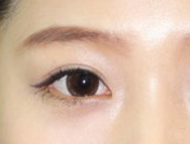 做完開眼角效果好嗎？開眼角術(shù)后注意事項(xiàng)有哪些？