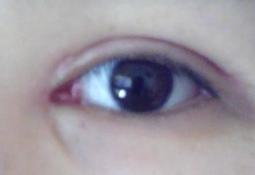 做完雙眼皮開內(nèi)眼角有風(fēng)險嗎？做完開眼角怎樣護(hù)理？