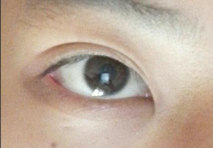 開眼角手術(shù)后會(huì)影響視力嗎？開眼角手術(shù)費(fèi)用貴嗎？