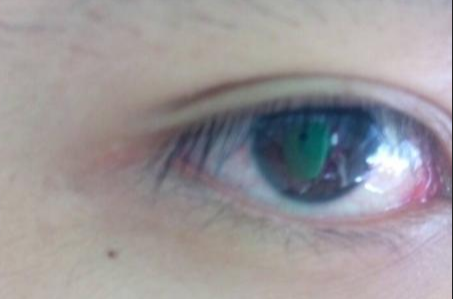 開眼角手術(shù)完全恢復(fù)需要多長時間？術(shù)后如何避免留疤？