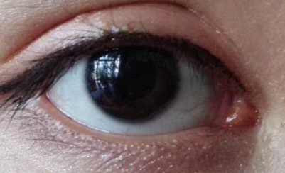 做完開(kāi)眼角疼不疼？