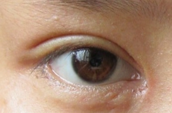 開眼角手術(shù)后會不會留疤？