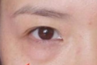 光纖溶脂去眼袋手術有哪些優(yōu)勢？