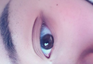 不開刀祛眼袋效果怎么樣？玻尿酸祛眼袋多少錢呢？