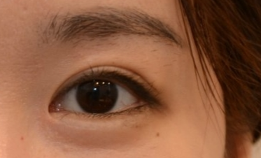 玻尿酸能祛眼袋嗎？