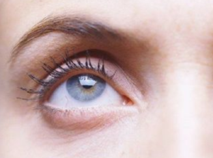 埋線祛眼袋什么時(shí)候做好？