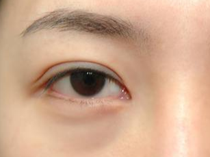 光纖溶脂去眼袋要多久消腫？術(shù)后如何護(hù)理？