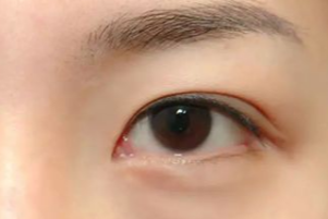 光纖溶脂祛眼袋有效果嗎？光纖溶脂祛眼袋好不好？