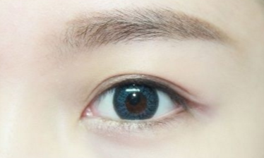 開眼角需要注意的事項有哪些？