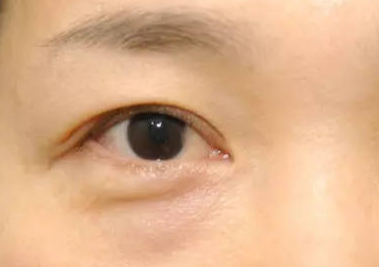 什么是埋線去眼袋？