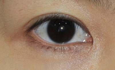 玻尿酸去眼袋安全有效嗎？