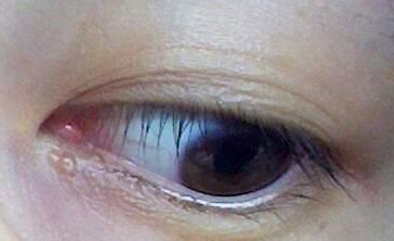 不開(kāi)刀去眼袋多少錢(qián)？