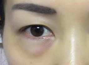 光纖溶脂去眼袋術(shù)后如何護(hù)理？