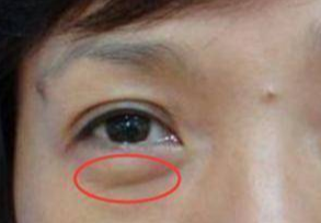 埋線去眼袋能維持多久？