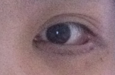 埋線去眼袋有效嗎？