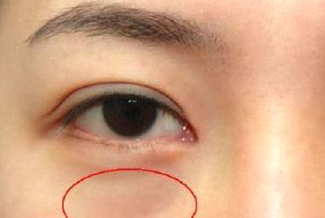 光纖溶脂祛眼袋需要多少錢(qián)？光纖溶脂怎么樣呢？