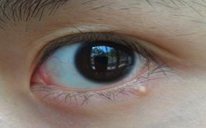 不開(kāi)刀去眼袋安全嗎？