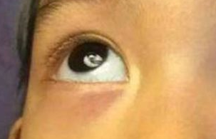 激光祛眼袋需要多少錢？