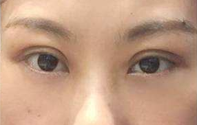 激光去眼袋能維持多長(zhǎng)時(shí)間？祛眼袋的手術(shù)效果好嗎？