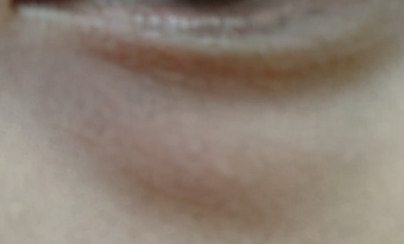 激光去眼袋和內(nèi)切哪個好？