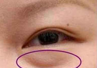 激光去眼袋有什么好處？激光祛眼袋有用嗎？