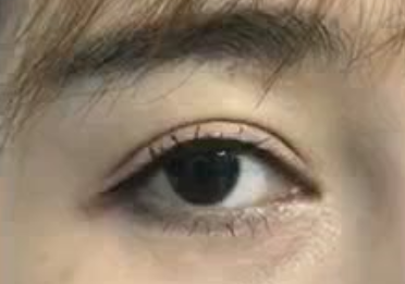 激光祛眼袋痛不痛？激光祛眼袋手術(shù)怎么樣？