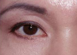 激光可以去眼袋嗎？祛除眼袋是用激光好還是手術(shù)好？