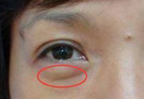 激光祛眼袋要多少錢？