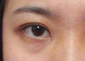 去眼袋是激光好還是內(nèi)切好？激光祛眼袋是什么原理？