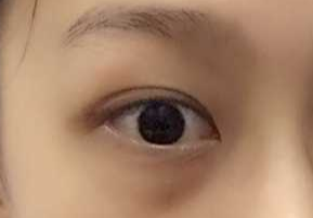 激光祛眼袋要多少錢(qián)？