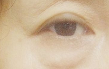 激光祛眼袋能維持多長(zhǎng)時(shí)間？