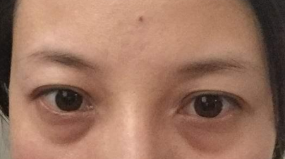 激光祛除眼袋有效嗎？