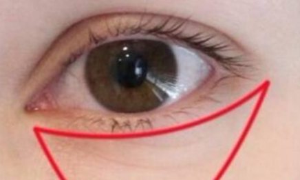 激光祛眼袋有什么利弊？