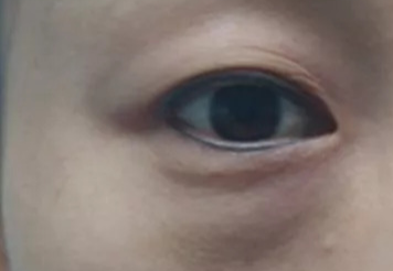 激光去眼袋可以管多久？