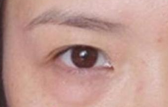 激光去除眼袋后遺癥有哪些？