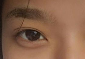 激光去眼袋后需多久能恢復(fù)？激光去眼袋快速有效嗎？