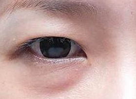 激光去眼袋的方法效果好嗎？激光去眼袋有什么壞處？