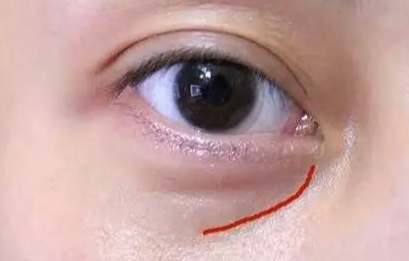 激光去眼袋手術(shù)費(fèi)用是多少？