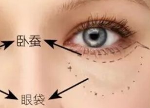 激光祛眼袋多久才能恢復(fù)？