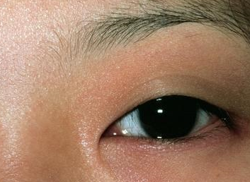 激光祛眼袋可靠嗎？激光去眼袋會不會留疤？