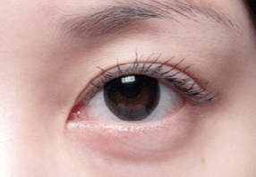 激光去眼袋會不會很疼？