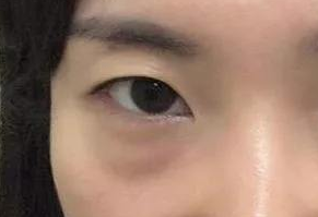 激光祛眼袋會疼嗎？