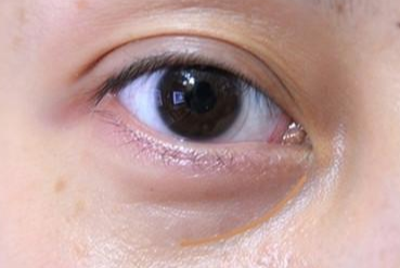 激光去眼袋多長時(shí)間能消腫？激光去眼袋能維持幾年？