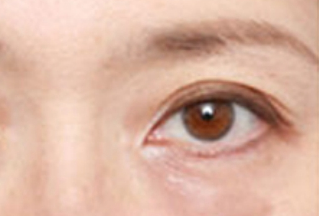 激光去眼袋幾天能恢復(fù)？激光去眼袋是怎樣的？