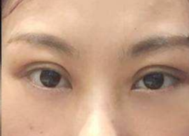 激光去眼袋可保持多久？激光去除眼袋效果好不好？