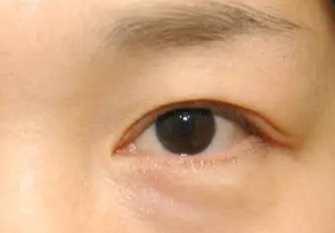 激光去眼袋術后會不會反彈？