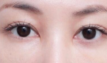 激光去眼袋術后注意事項有哪些？