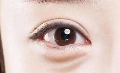 激光去眼袋是永久的嗎？激光去眼袋多少錢？