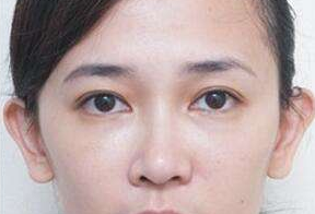 激光去眼袋后要休息多久呢？激光去眼袋會很痛嗎？