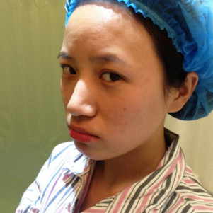 全臉脂肪填充效果對比圖